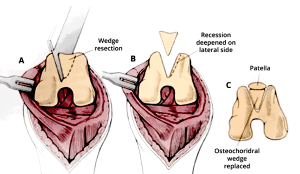 Patellar luxation in dogs - sulcoplasty surgery