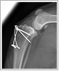 Patellar luxation in dogs - • Tibial tuberosity transposition